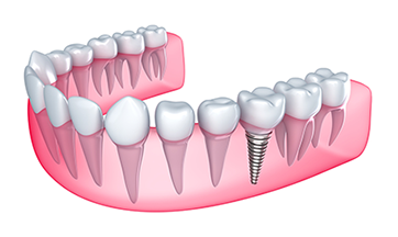 Dental Implants Louisville