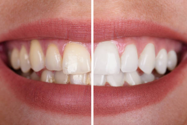 Photograph of smile showing before and after Teeth Whitening, Louisville, KY
